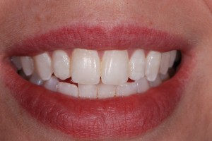 Beechwood dental care » Tooth Whitening, ‘Icon’ and Microabrasion